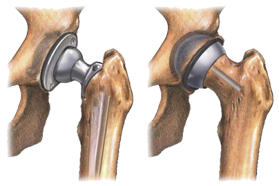 Prosthetic Implants